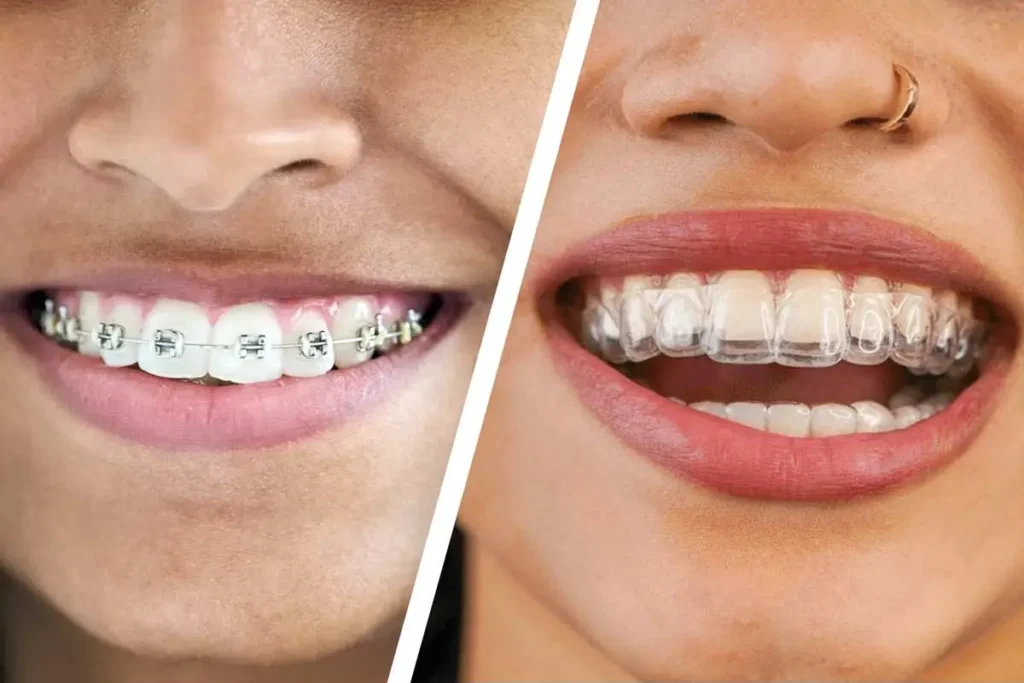 Invisible Braces vs Traditional Braces Comparison