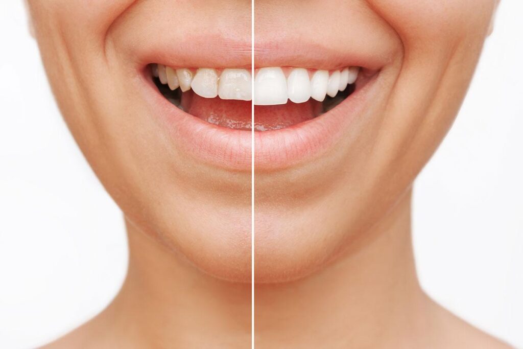 Smile Makeover Before and After Results